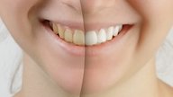 Cómo blanquear los dientes: 8 tratamientos efectivos