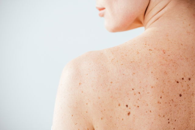 Skin Discoloration Has Many Causes—and Just As Many Treatment Options