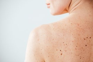 8 tipos comuns de manchas escuras na pele (e como tratar)