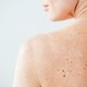8 tipos comuns de manchas escuras na pele (e como tratar)