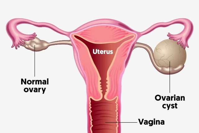 ovarian cyst pain location