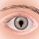 Calázio no olho: o que é, sintomas, causas e tratamento