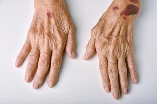Manchas moradas en la piel: 10 causas y cómo tratar