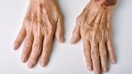 Manchas moradas en la piel: 10 causas y cómo tratar