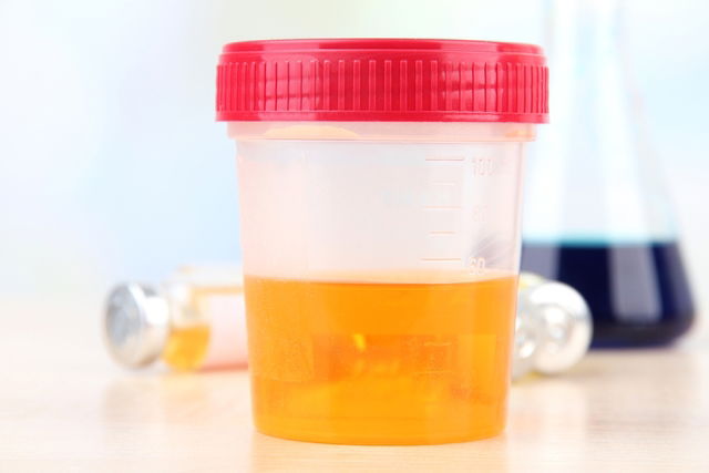 bilirubin in urine