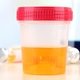 Urobilinogênio na urina: o que pode ser e o que fazer