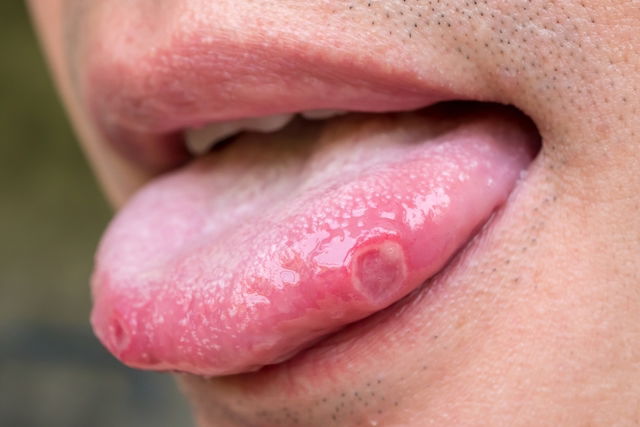 Canker sore on side of the tongue