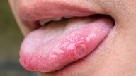 Afta na língua: sintomas, causas e tratamento