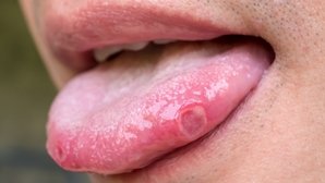 Afta na língua: sintomas, causas e tratamento