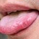 Canker Sore on Tongue: Symptoms, Causes & Treatment