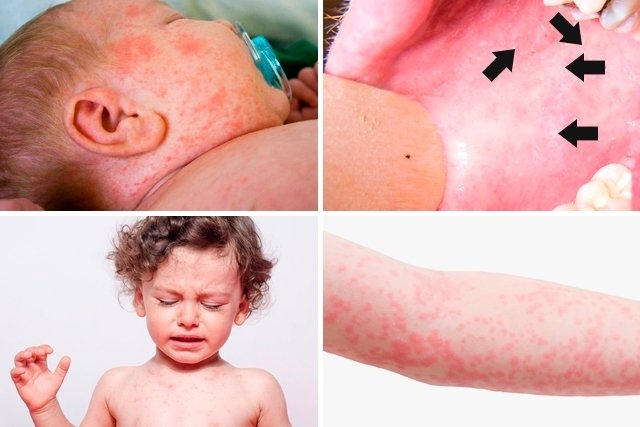 Fotos do sarampo em crianças