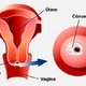 Cáncer cervicouterino: qué es, principales causas y cómo prevenirlo