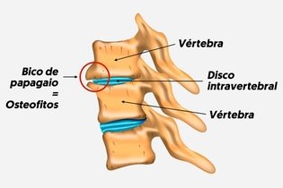 Imagen ilustrativa del artículo Picos de loro (osteofitos): qué son, síntomas y tratamiento