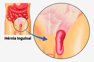 Imagem ilustrativa do artigo Hérnia inguinal: sintomas, causas, cirurgia e recuperação