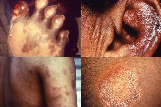 La lepra, una enfermedad que no ha sido derrotada