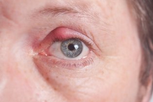 Illustrative image of the article How to Get Rid of a Stye: 5 Easy Home Remedies