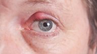 How To Get Rid of a Stye: 5 Natural Remedies