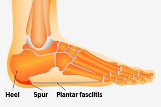Illustrative image of the article Plantar Fasciitis: What Is, Symptoms, Causes & Treatment