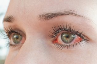 Olho vermelho: 13 causas comuns e o que fazer