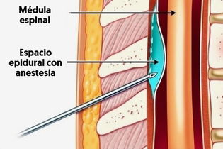 Indicaciones de la Anestesia Epidural y posibles efectos ...