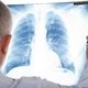 Infección pulmonar: síntomas, causas y tratamiento
