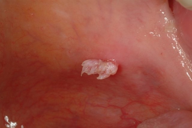 papilloma virus na boca