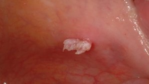Papiloma en ano sintomas - etigararunway.ro - Signos de papiloma en la boca