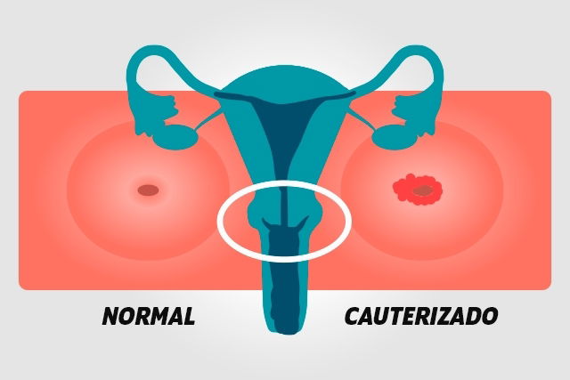 Cauteriza O Do Colo Do Tero O Que Como Feita E Recupera O Tua Sa De