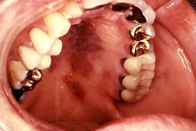 Foto de cáncer de boca