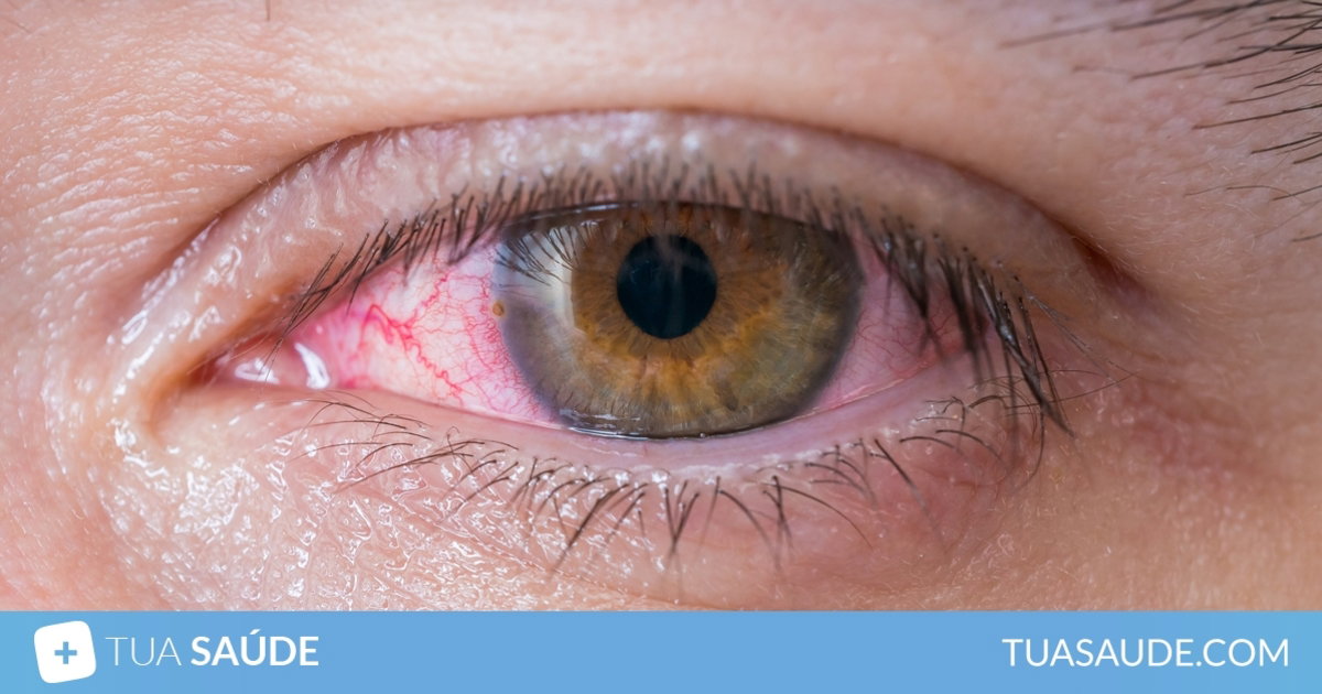 Olho vermelho: 9 causas comuns e o que fazer - Tua Saúde