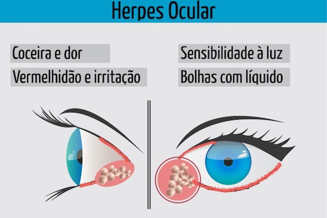 Entenda o que é a Herpes nos Olhos