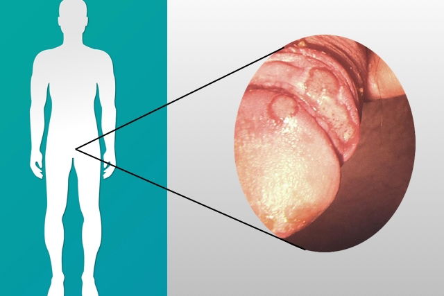 Mannelijke candidiasis foto