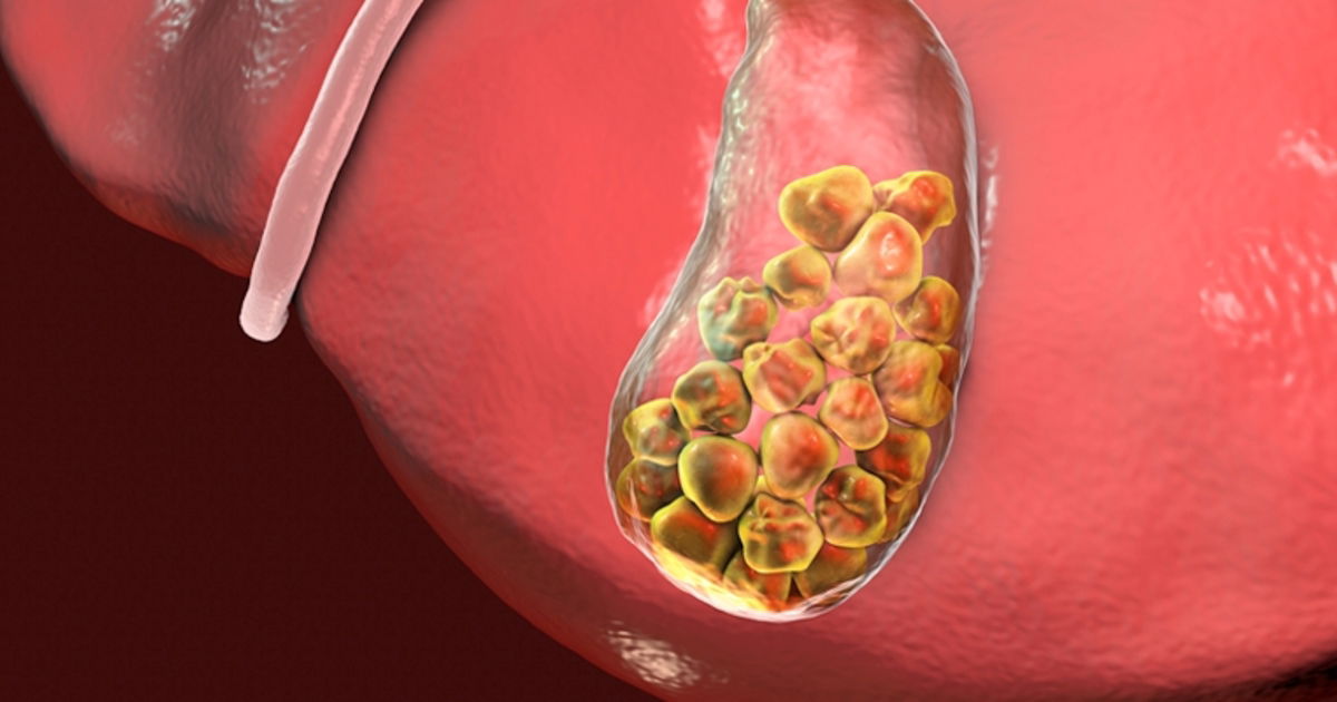Pedra Na Vesicula Causas - MODISEDU
