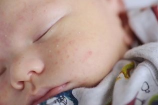 Imagem ilustrativa do artigo Acne neonatal: o que é e como tratar as espinhas no bebê