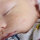 Acne neonatal: o que é e como tratar as espinhas no bebê