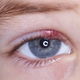 Terçol é contagioso? Entenda como se pega e como evitar