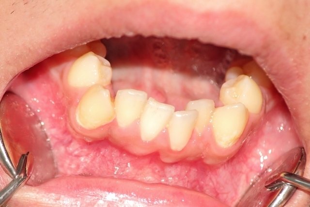 Qual médico trata o maxilar ou mandíbula estalando? - Tua Saúde