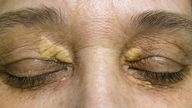High Cholesterol Symptoms: 3 Signs to Look Out For