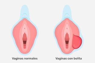 Imagen ilustrativa del artículo Bolitas en los labios mayores: 11 causas y qué hacer (con foto)