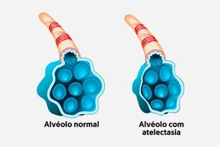 Imagem ilustrativa do artigo O que é atelectasia pulmonar, principais sintomas e tratamento