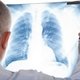Pneumonia bilateral: o que é, sintomas e como tratar