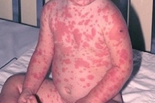 Criança com manchas no tronco, barriga e braços característicos da necrólise epidérmica tóxica