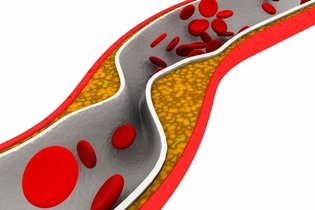 Colesterol HDL bajo: síntomas, causas y cómo subirlo