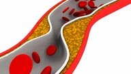 Colesterol HDL bajo: síntomas, causas y cómo subirlo