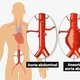 Aneurisma de aorta: o que é, sintomas, tratamento e cirurgia