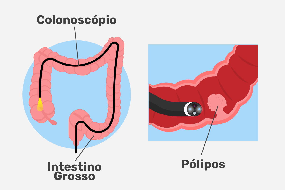 Colonoscopia O Que é Para Que Serve Preparo E Como é Feita Tua Saúde 8740