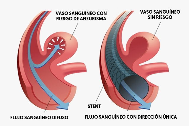 Qué es un aneurisma cerebral, síntomas, causas y tratamiento - Tua Saúde