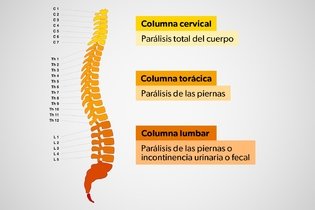 Imagen ilustrativa del artículo Fractura de columna: síntomas, tratamiento y recuperación 