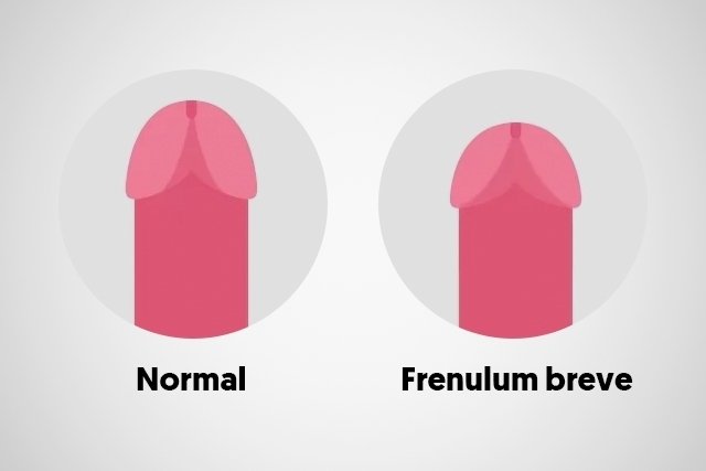 Frenulum breve is a condition in which the piece of skin that connects the ...