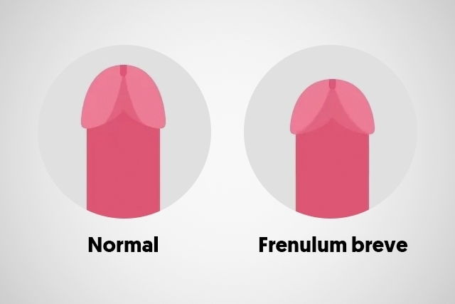 Operation frenulum breve How to